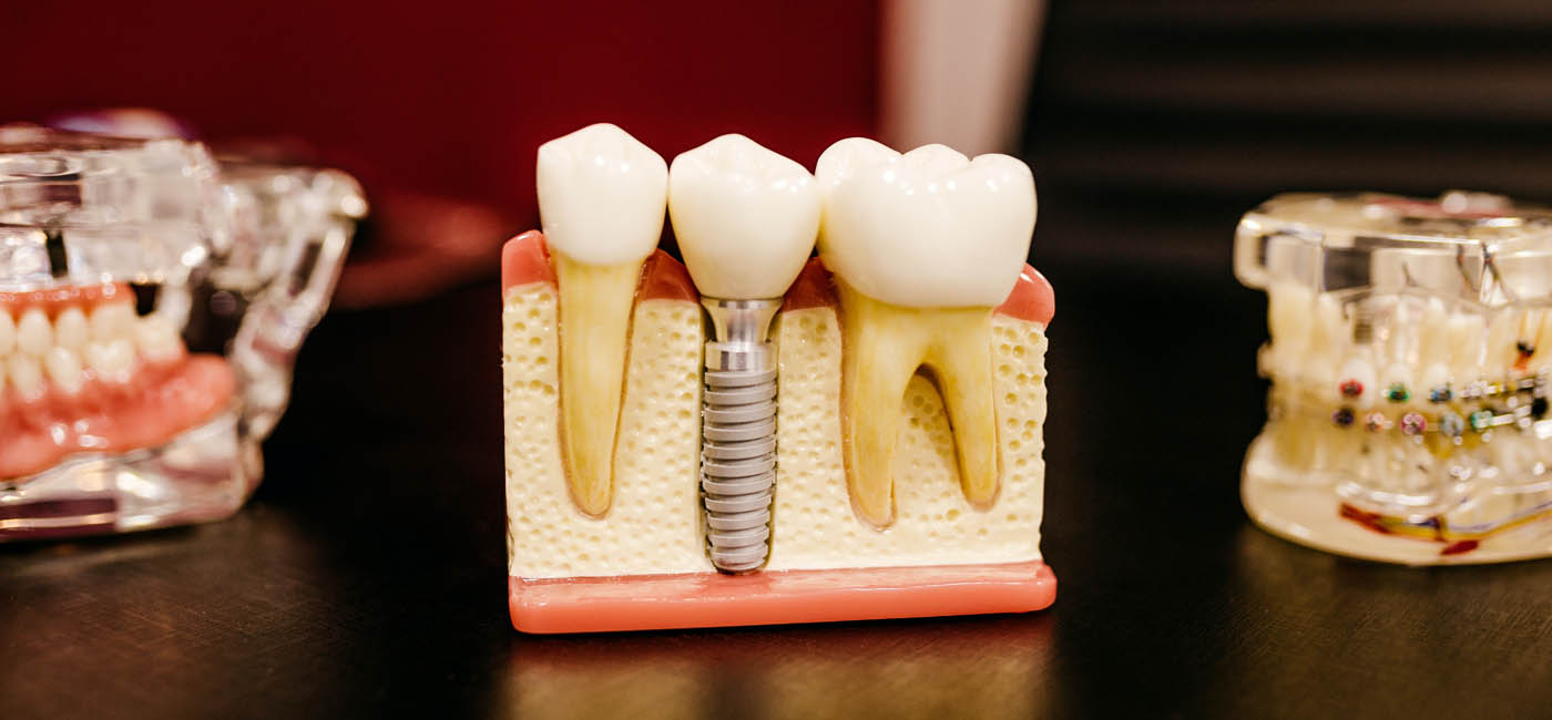 Dental Implants